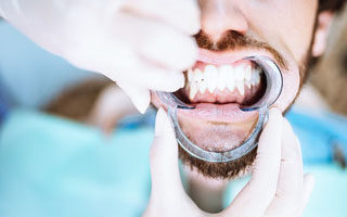 sbiancamento dentale - Dentista Leone Cinisi
